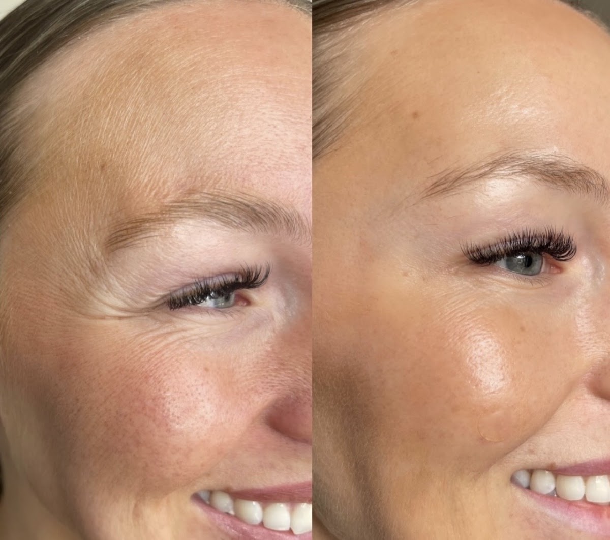 Before and after: Anti-wrinkle & skin by Emman Amir