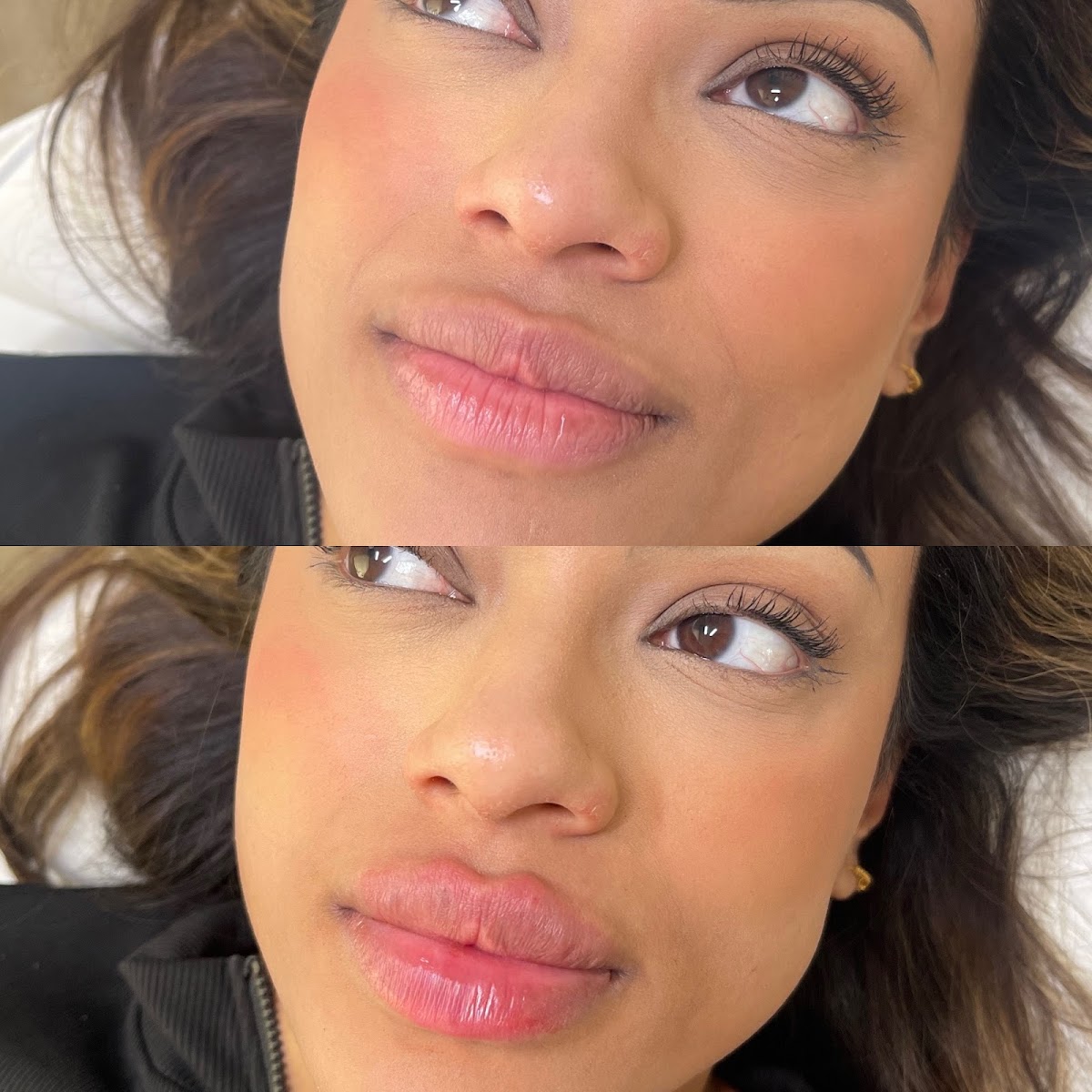 Before and after a natural lip filler treatment by Emman Amir