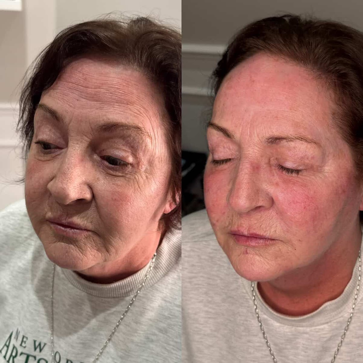 Before and after: Skin treatment by Emman Amir